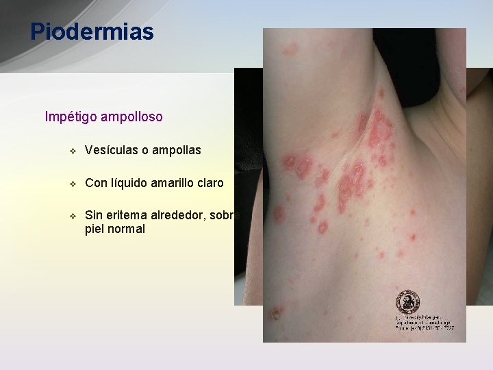 Piodermias Impétigo ampolloso v Vesículas o ampollas v Con líquido amarillo claro v Sin