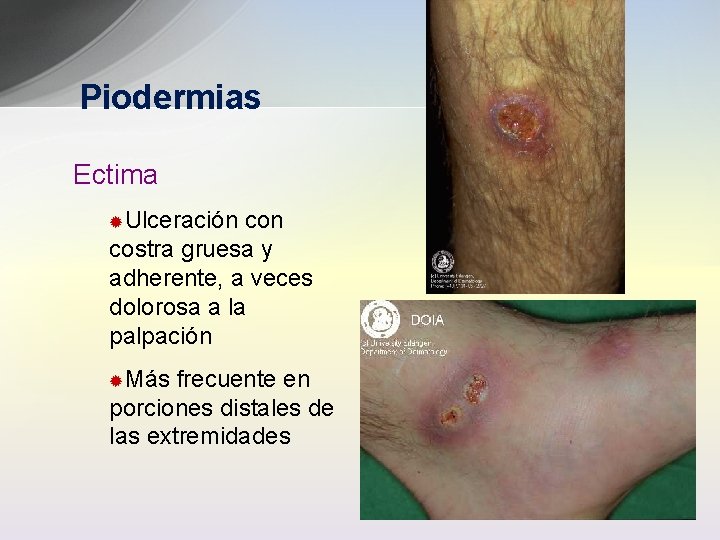 Piodermias Ectima ®Ulceración con costra gruesa y adherente, a veces dolorosa a la palpación