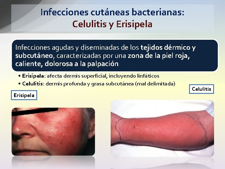 Infecciones cutáneas bacterianas: Celulitis y Erisipela Infecciones agudas y diseminadas de los tejidos dérmico