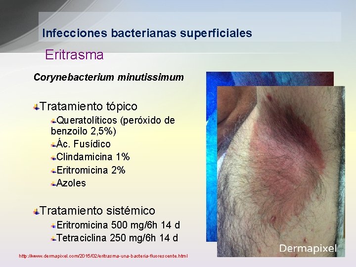 Infecciones bacterianas superficiales Eritrasma Corynebacterium minutissimum Tratamiento tópico Queratolíticos (peróxido de benzoilo 2, 5%)
