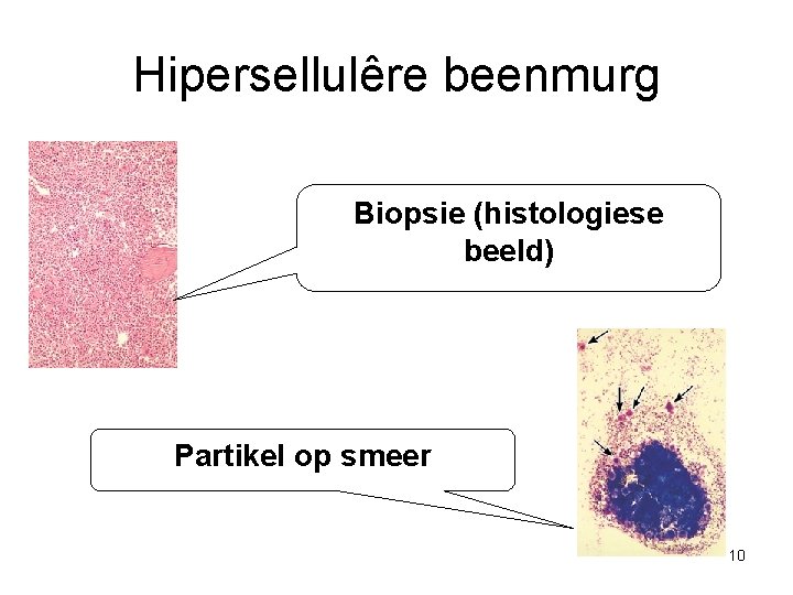 Hipersellulêre beenmurg Biopsie (histologiese beeld) Partikel op smeer 10 