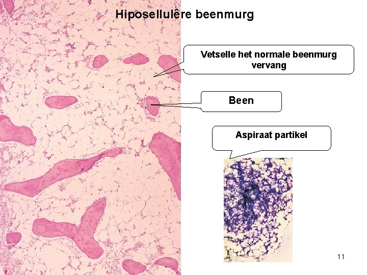 Hiposellulêre beenmurg Vetselle het normale beenmurg vervang Been Aspiraat partikel 11 