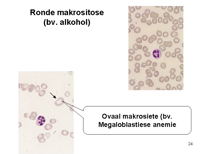 Ronde makrositose (bv. alkohol) Ovaal makrosiete (bv. Megaloblastiese anemie 24 