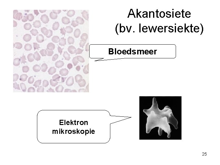 Akantosiete (bv. lewersiekte) Bloedsmeer Elektron mikroskopie 25 