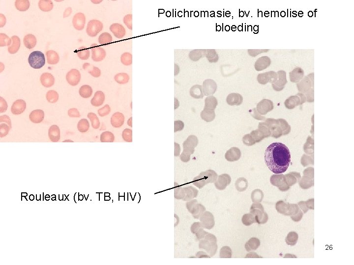 Polichromasie, bv. hemolise of bloeding Rouleaux (bv. TB, HIV) 26 