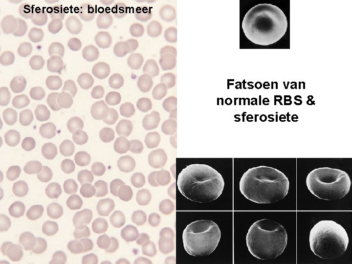 Sferosiete: bloedsmeer Fatsoen van normale RBS & sferosiete 27 