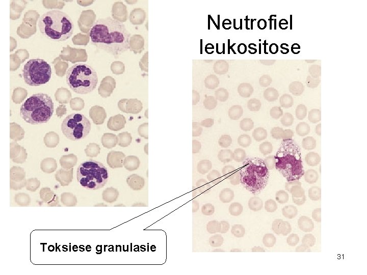 Neutrofiel leukositose Toksiese granulasie 31 