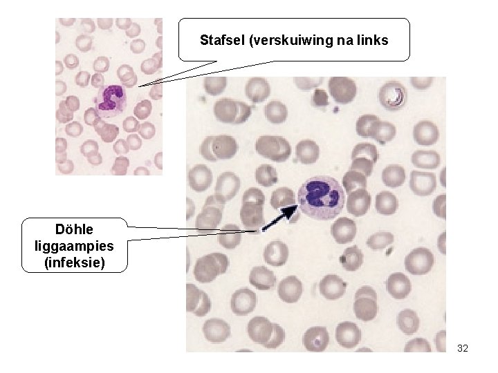 Stafsel (verskuiwing na links Döhle liggaampies (infeksie) 32 