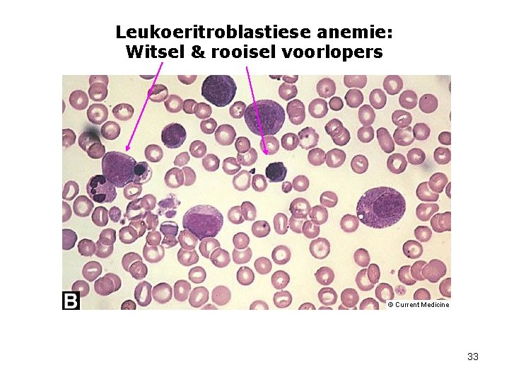 Leukoeritroblastiese anemie: Witsel & rooisel voorlopers 33 