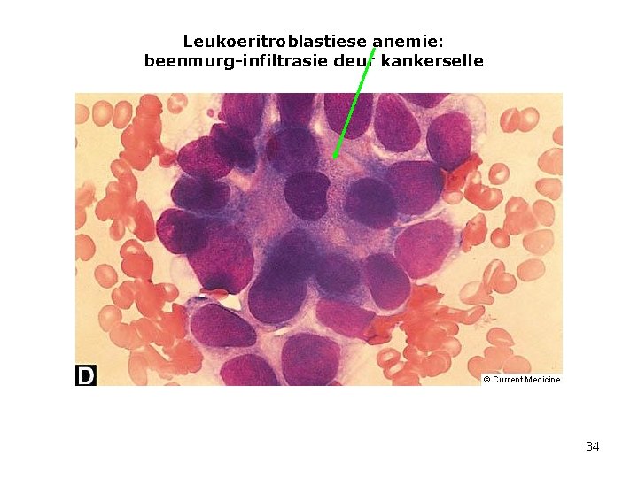Leukoeritroblastiese anemie: beenmurg-infiltrasie deur kankerselle 34 