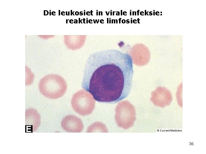 Die leukosiet in virale infeksie: reaktiewe limfosiet 36 