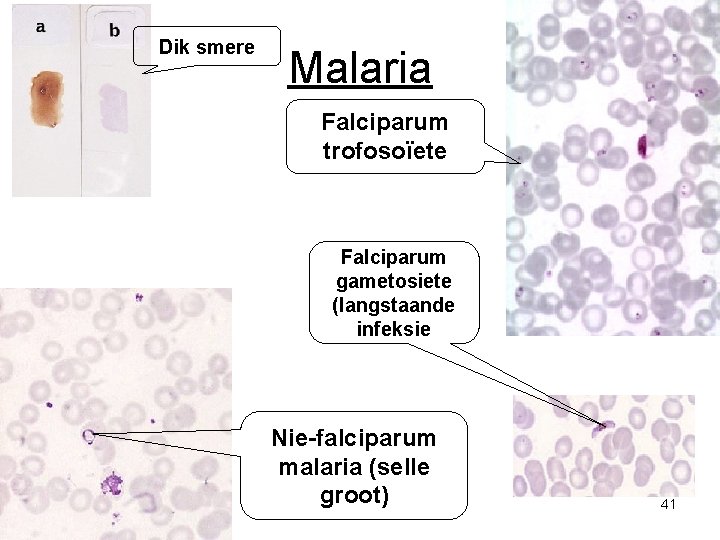 Dik smere Malaria Falciparum trofosoïete Falciparum gametosiete (langstaande infeksie Nie-falciparum malaria (selle groot) 41