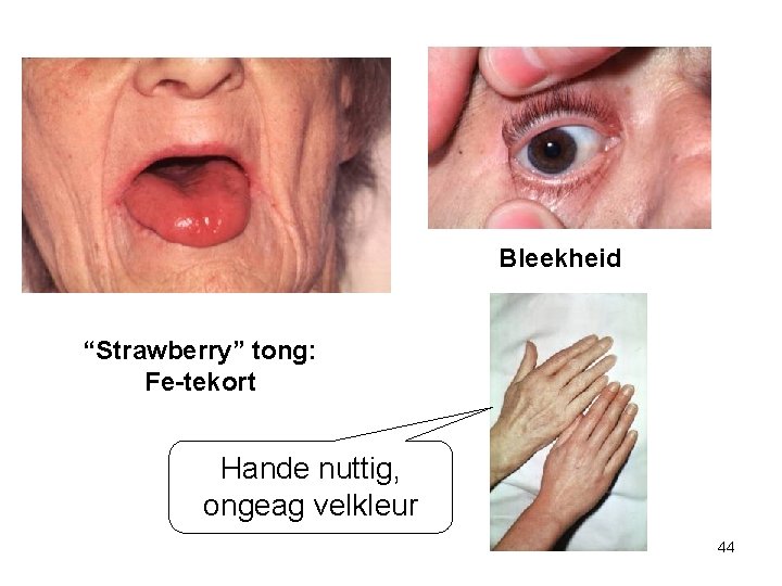 Bleekheid “Strawberry” tong: Fe-tekort Hande nuttig, ongeag velkleur 44 