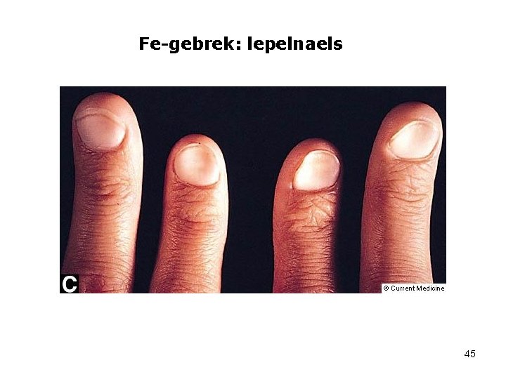 Fe-gebrek: lepelnaels 45 