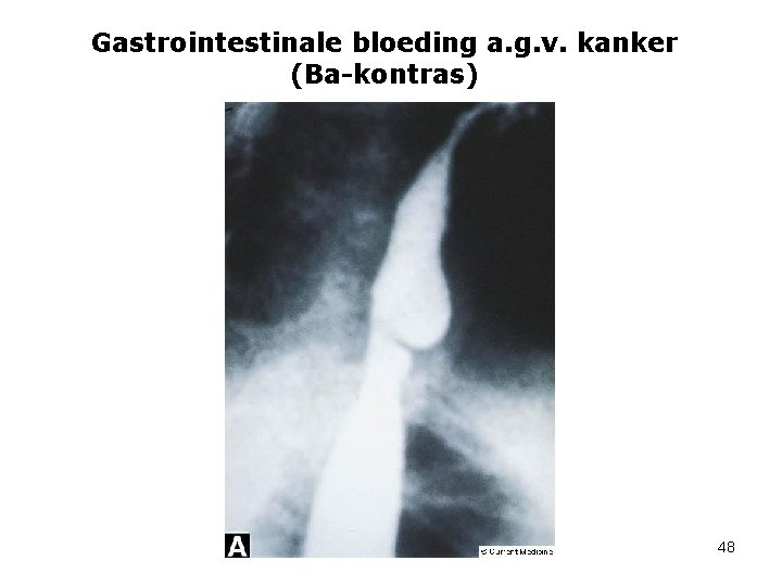 Gastrointestinale bloeding a. g. v. kanker (Ba-kontras) 48 