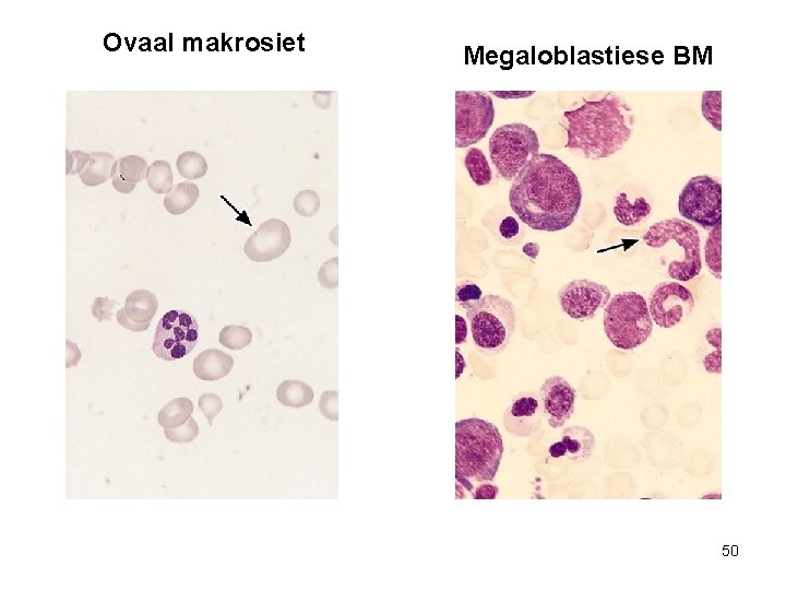 Ovaal makrosiet Megaloblastiese BM 50 