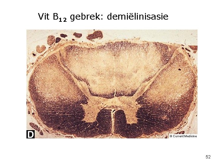 Vit B 12 gebrek: demiëlinisasie 52 