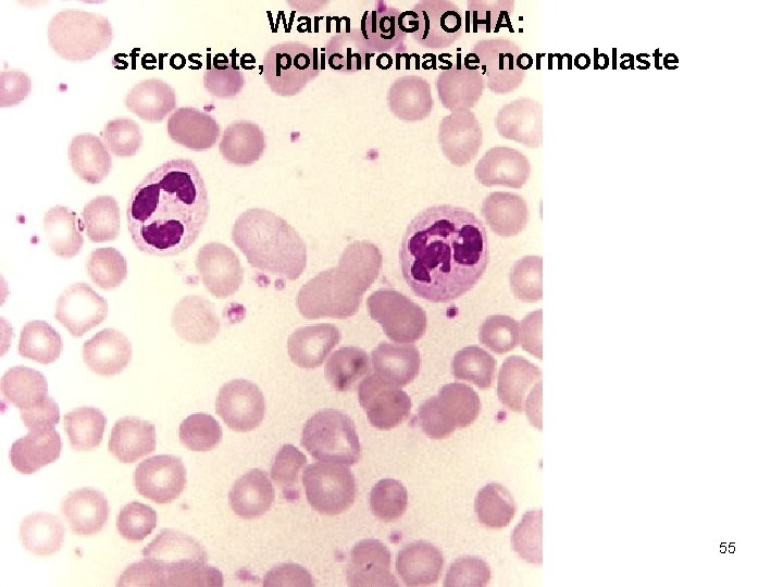 Warm (Ig. G) OIHA: sferosiete, polichromasie, normoblaste 55 