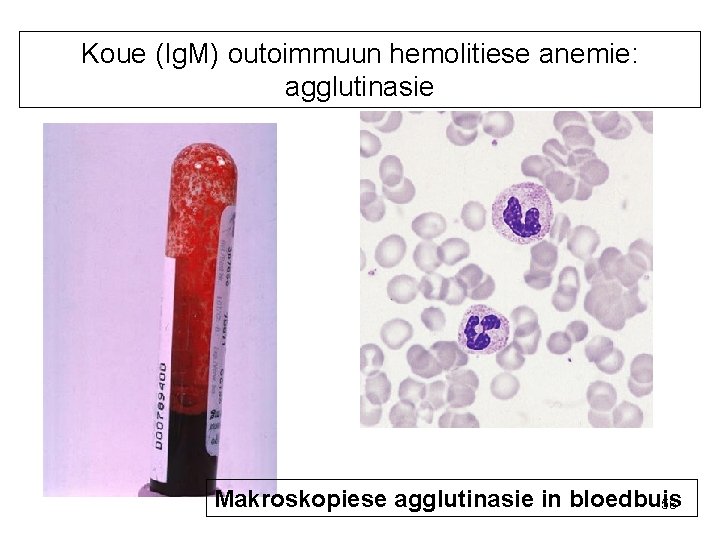 Koue (Ig. M) outoimmuun hemolitiese anemie: agglutinasie Makroskopiese agglutinasie in bloedbuis 56 