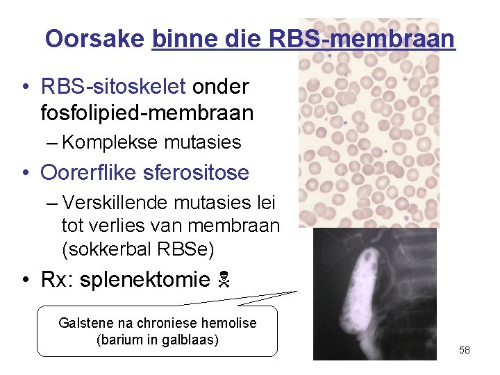 Oorsake binne die RBS-membraan • RBS-sitoskelet onder fosfolipied-membraan – Komplekse mutasies • Oorerflike sferositose