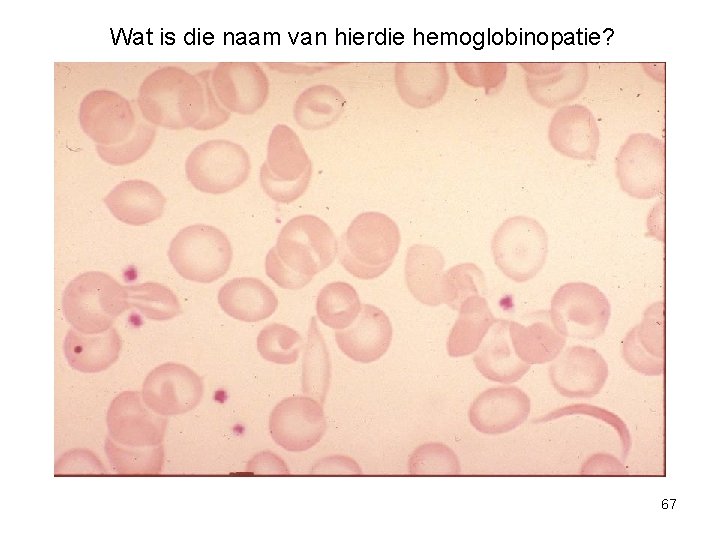 Wat is die naam van hierdie hemoglobinopatie? 67 