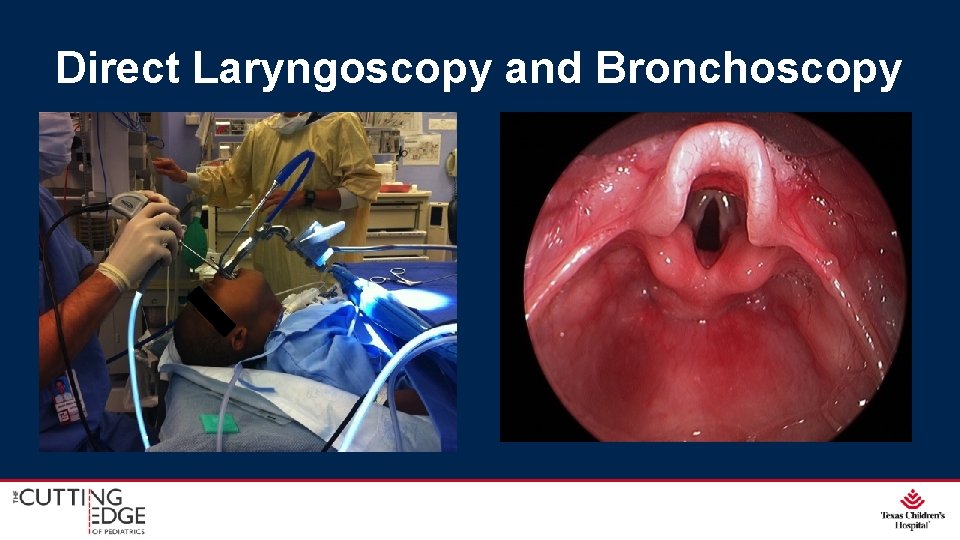 Direct Laryngoscopy and Bronchoscopy Direct Laryngoscopy and Bronchoscopy