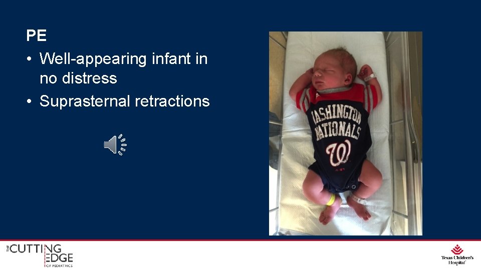 PE • Well-appearing infant in no distress • Suprasternal retractions 