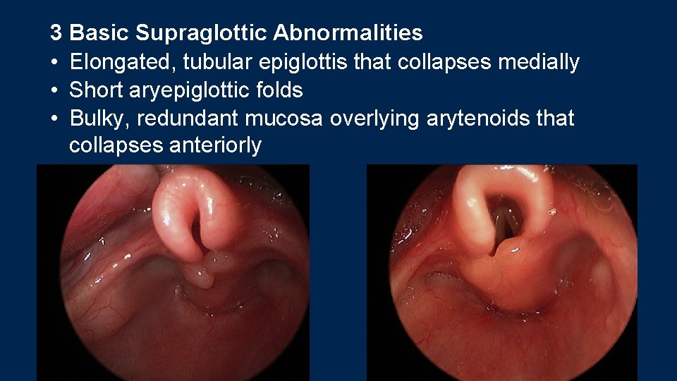 3 Basic Supraglottic Abnormalities • Elongated, tubular epiglottis that collapses medially • Short aryepiglottic 3 Basic Supraglottic Abnormalities • Elongated, tubular epiglottis that collapses medially • Short aryepiglottic