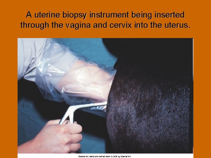 A uterine biopsy instrument being inserted through the vagina and cervix into the uterus.