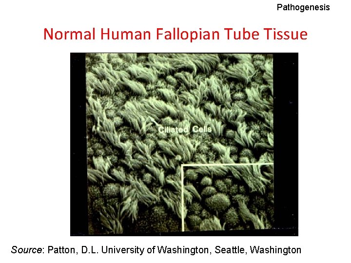 Pathogenesis Normal Human Fallopian Tube Tissue Source: Patton, D. L. University of Washington, Seattle,