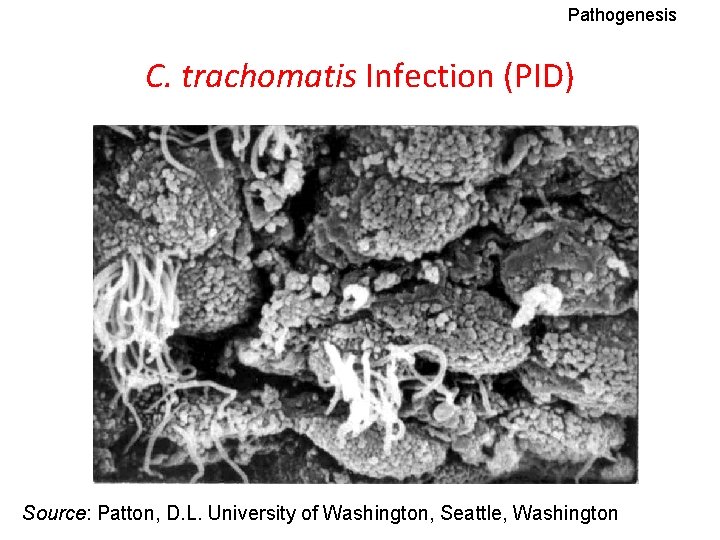 Pathogenesis C. trachomatis Infection (PID) Source: Patton, D. L. University of Washington, Seattle, Washington
