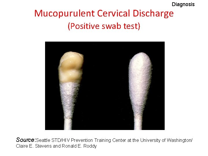 Diagnosis Mucopurulent Cervical Discharge (Positive swab test) Source: Seattle STD/HIV Prevention Training Center at