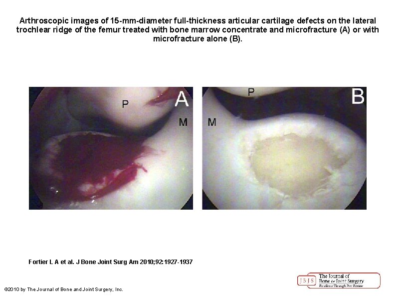 Arthroscopic images of 15 -mm-diameter full-thickness articular cartilage defects on the lateral trochlear ridge