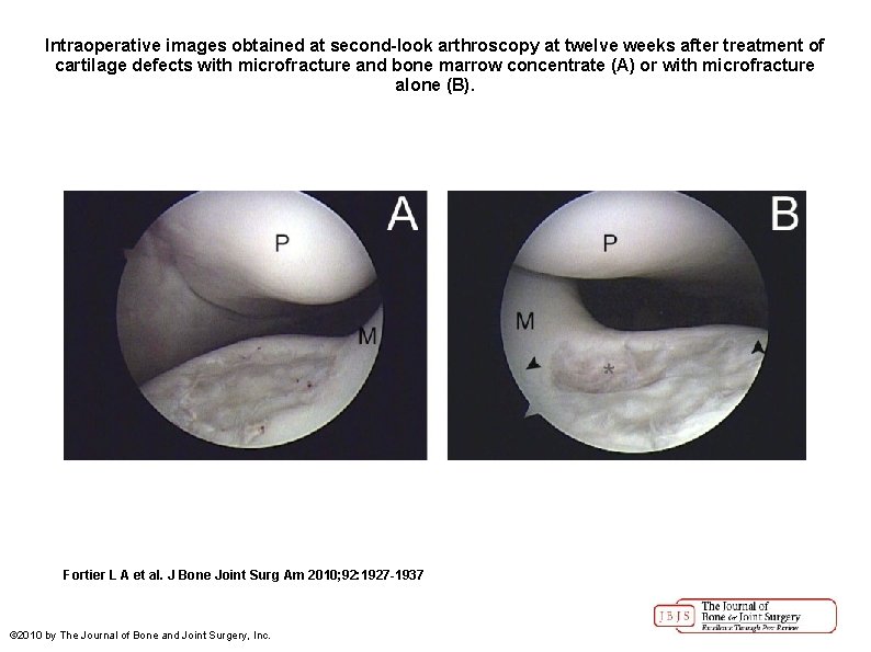 Intraoperative images obtained at second-look arthroscopy at twelve weeks after treatment of cartilage defects