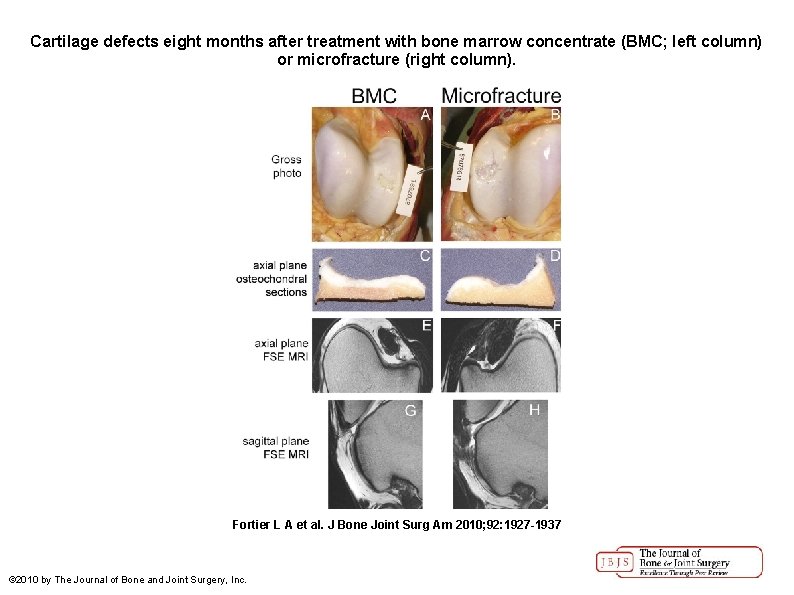 Cartilage defects eight months after treatment with bone marrow concentrate (BMC; left column) or
