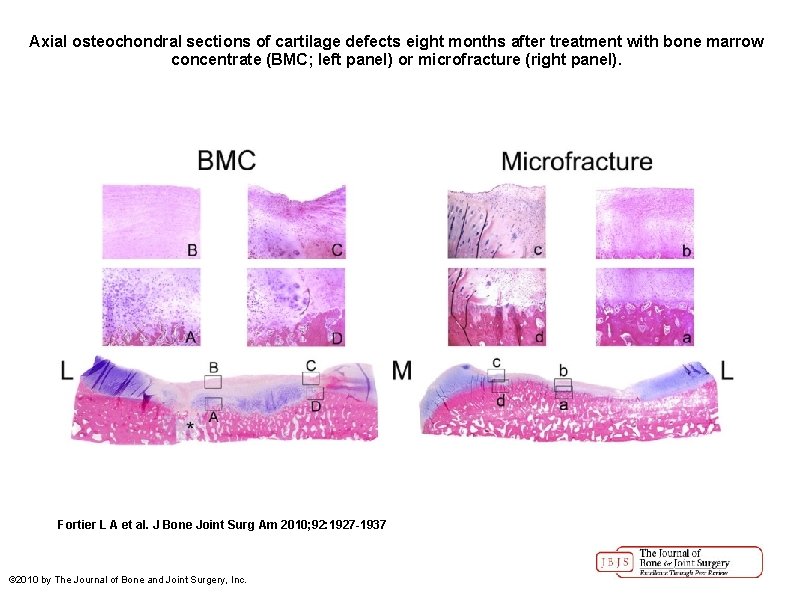 Axial osteochondral sections of cartilage defects eight months after treatment with bone marrow concentrate