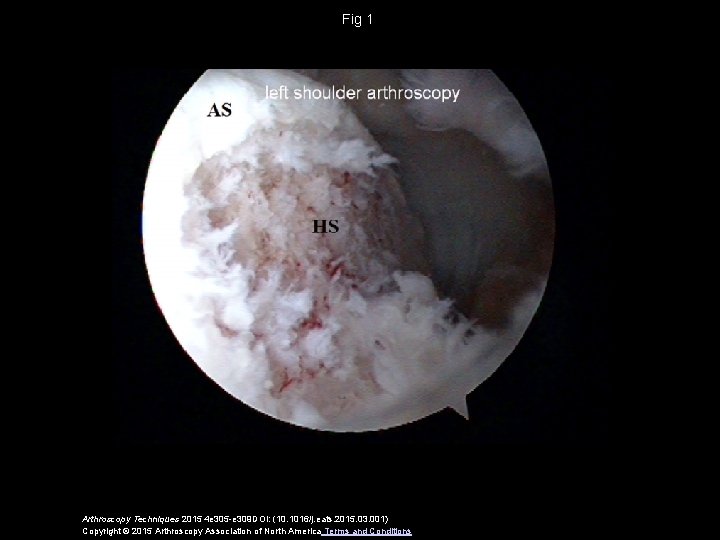 Fig 1 Arthroscopy Techniques 2015 4 e 305 -e 309 DOI: (10. 1016/j. eats.