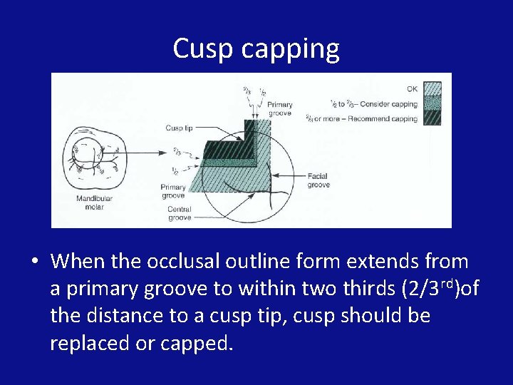 Cusp capping • When the occlusal outline form extends from a primary groove to