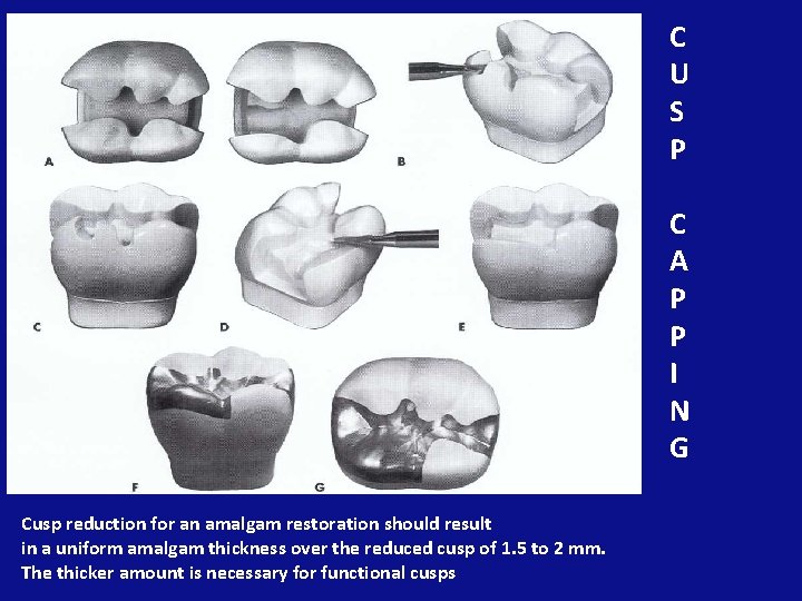 C U S P C A P P I N G Cusp reduction for