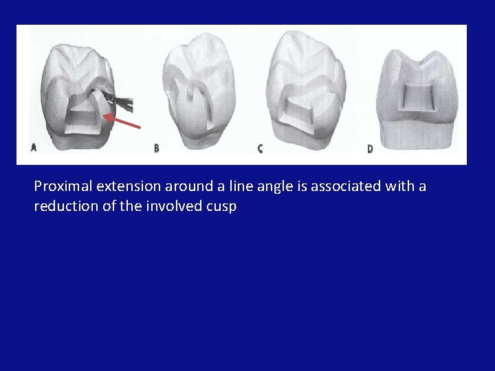 Proximal extension around a line angle is associated with a reduction of the involved