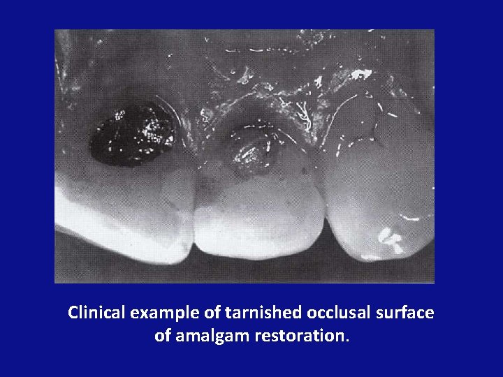 Clinical example of tarnished occlusal surface of amalgam restoration. 