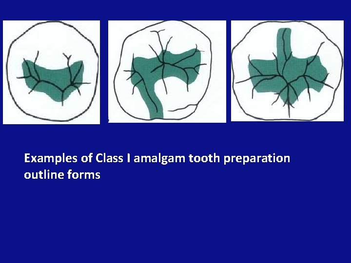 Examples of Class I amalgam tooth preparation outline forms 