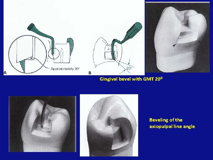 Gingival bevel with GMT 200 Beveling of the axiopulpal line angle 
