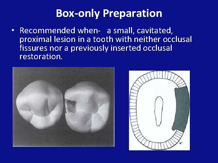 Box-only Preparation • Recommended when- a small, cavitated, proximal lesion in a tooth with