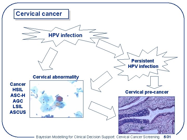 Cervical cancer HPV infection Persistent HPV infection Cervical abnormality Cancer HSIL ASC-H AGC LSIL