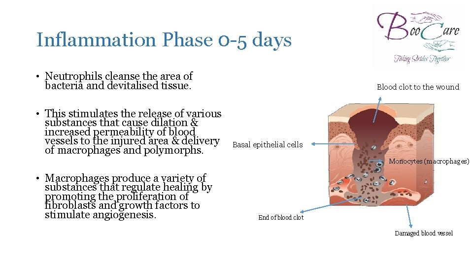 Inflammation Phase 0 -5 days • Neutrophils cleanse the area of bacteria and devitalised