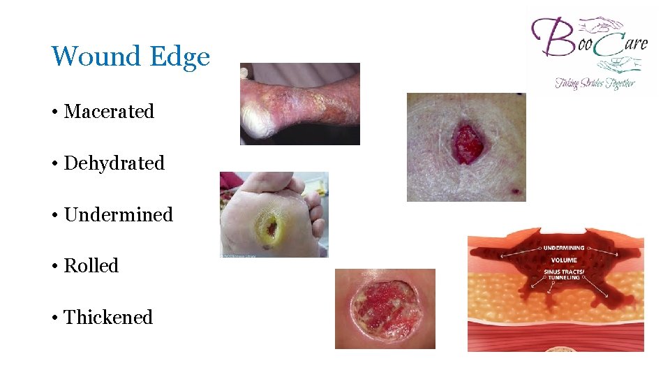 Wound Edge • Macerated • Dehydrated • Undermined • Rolled • Thickened 