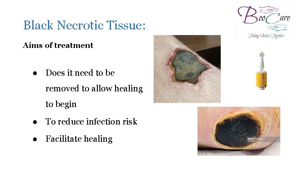 Managing Wounds Sally Irving Independent Tissue Viability Nurse