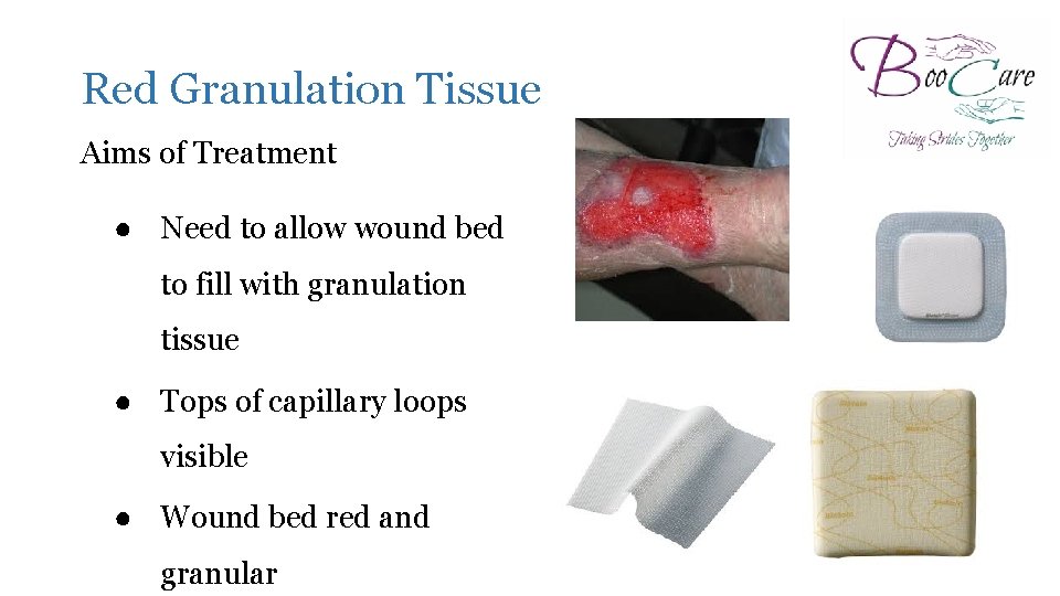 Red Granulation Tissue Aims of Treatment ● Need to allow wound bed to fill