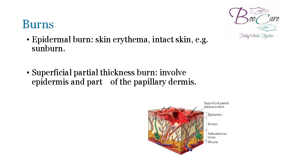 Burns • Epidermal burn: skin erythema, intact skin, e. g. sunburn. • Superficial partial